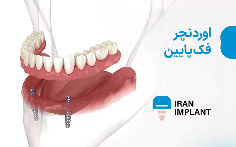 اوردنچر فک پایین