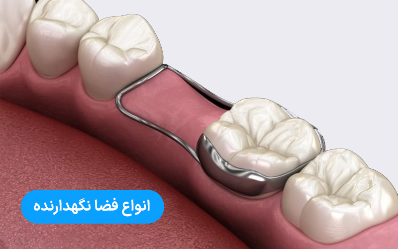 انواع فضانگهدارنده دندان کودک