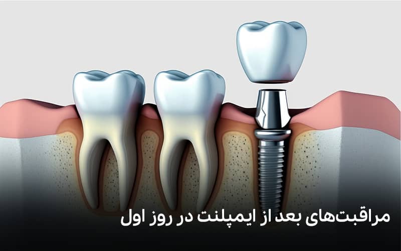 مراقبت‌های بعد از ایمپلنت در روز اول