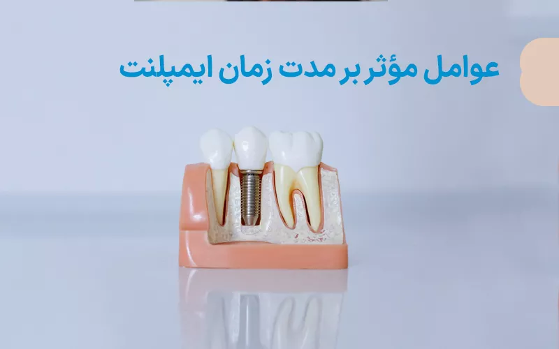 عوامل موثر بر مدت زمان ایمپلنت