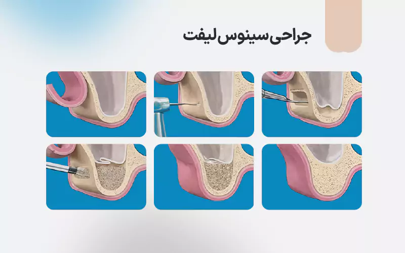 جراحی سینوس لیفت
