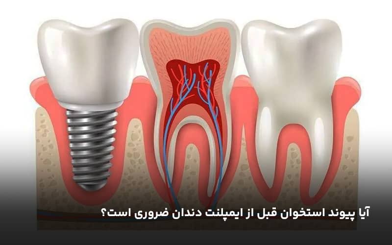 آیا پیوند استخوان قبل از ایمپلنت دندان ضروری است؟