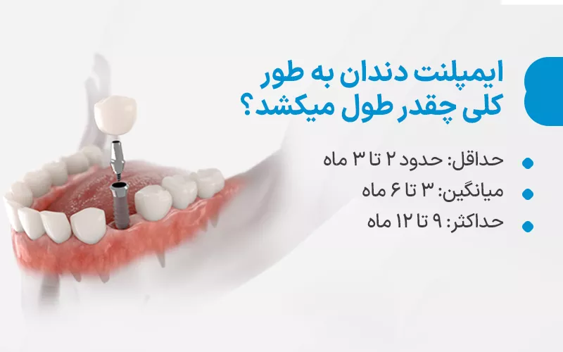 ایمپلنت چقدر طول میکشد؟