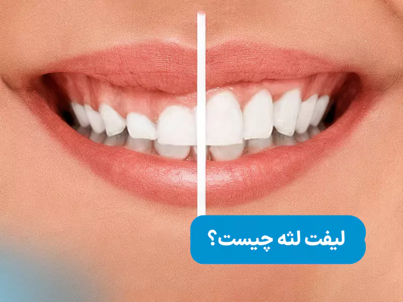لیفت لثه چیست؟
