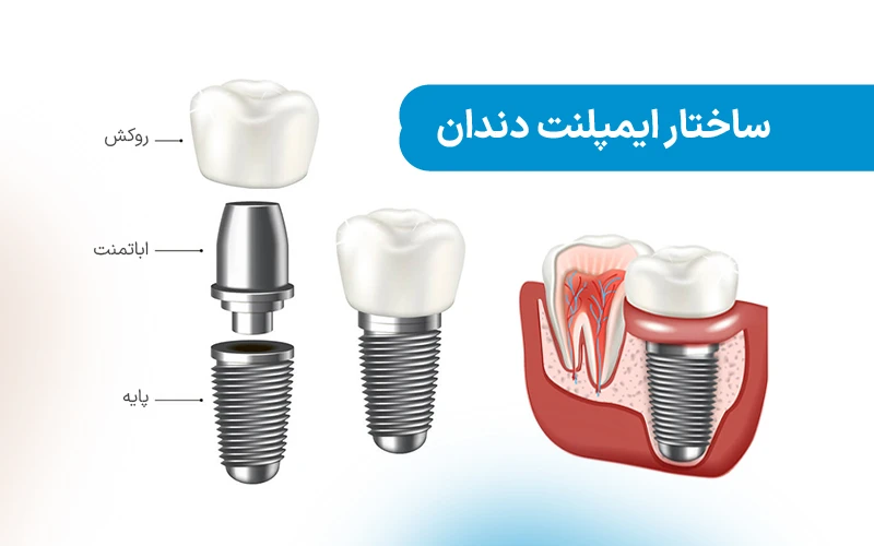 ساختار ایمپلنت دندان