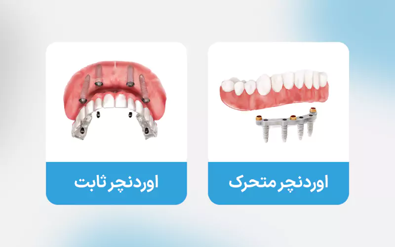 اوردنچر ثابت و متحرک