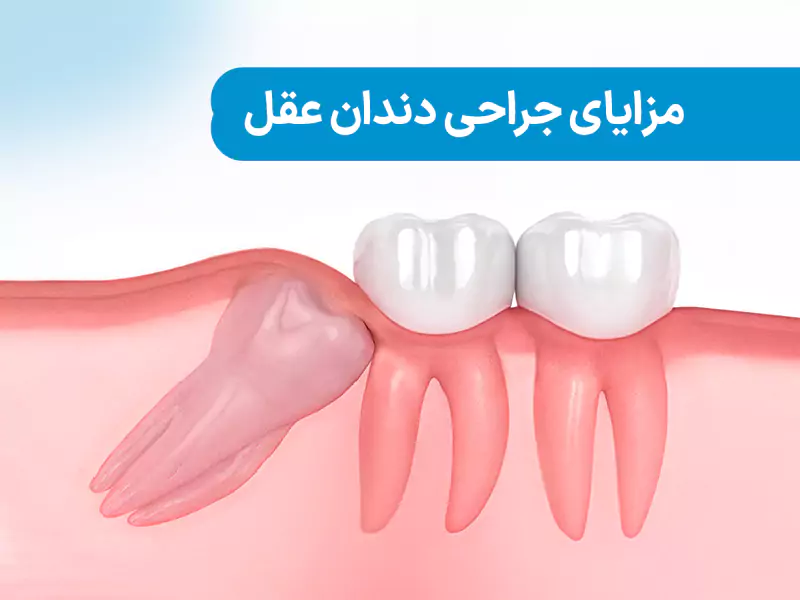 مزایای جراحی دندان عقل