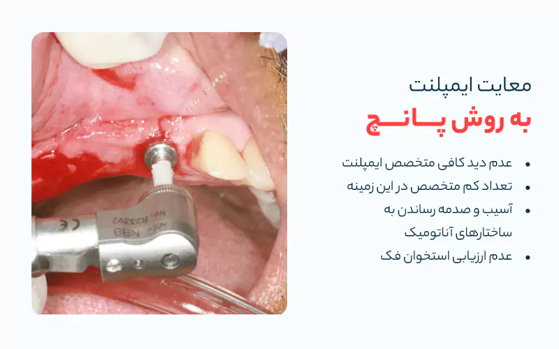 معایب ایمپلنت با پانچ