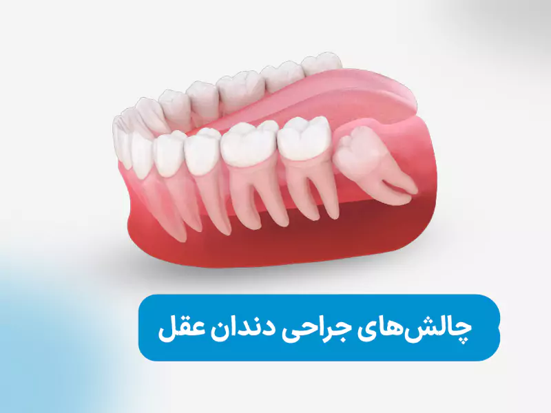 چالش‌های جراحی دندان عقل
