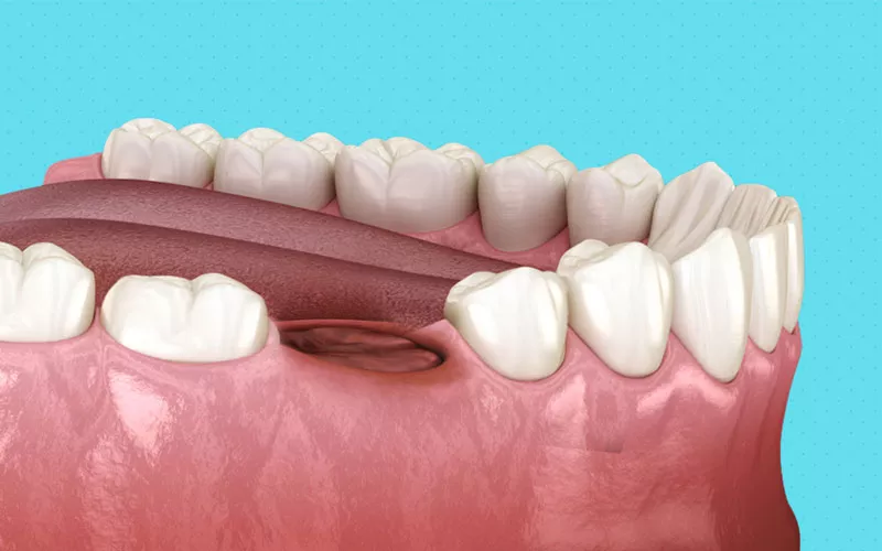 خشک شدن حفره دندان