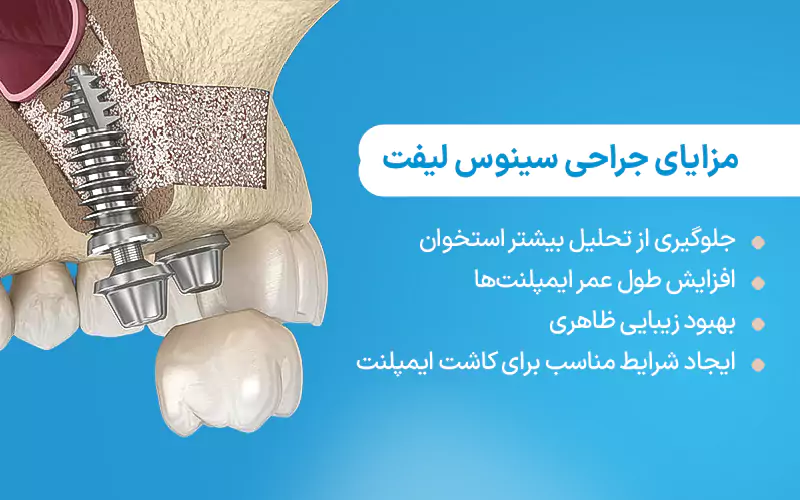 مزایای جراحی سینوس لیفت