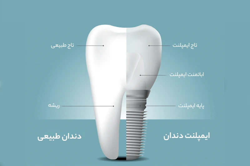 تفاوت ایمپلنت با دندان واقعی