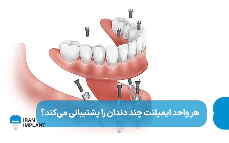 هر واحد ایمپلنت چند دندان را پشتیبانی میکند؟