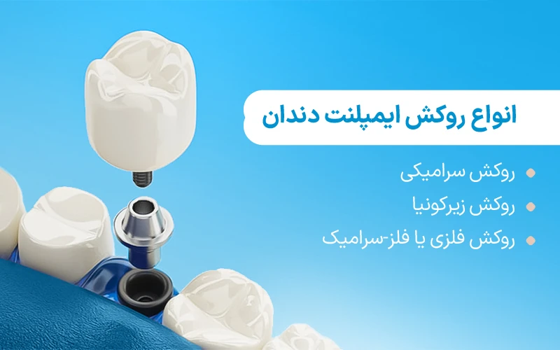انواع روکش ایمپلنت