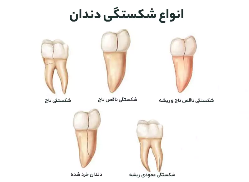 انواع شکستگی دندان
