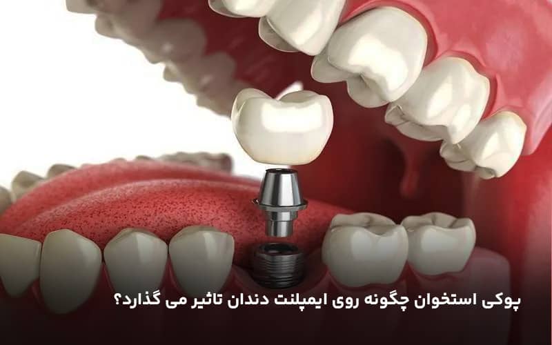 پوکی استخوان چگونه روی ایمپلنت دندان تاثیر می گذارد؟