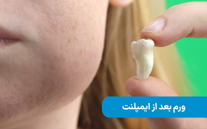 ورم بعد از ایمپلنت