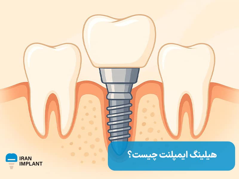 هیلینگ ایمپلنت چیست؟