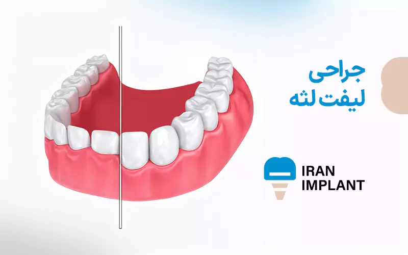 جراحی لیفت لثه