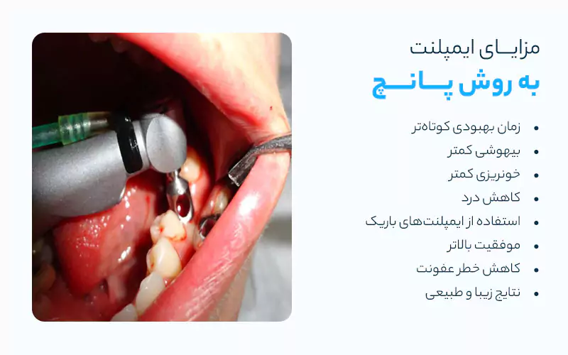 مزایای ایمپلنت به روش پانچ