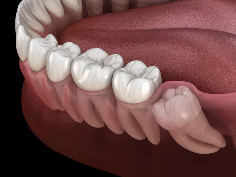 جراحی دندان عقل نهفته روی عصب