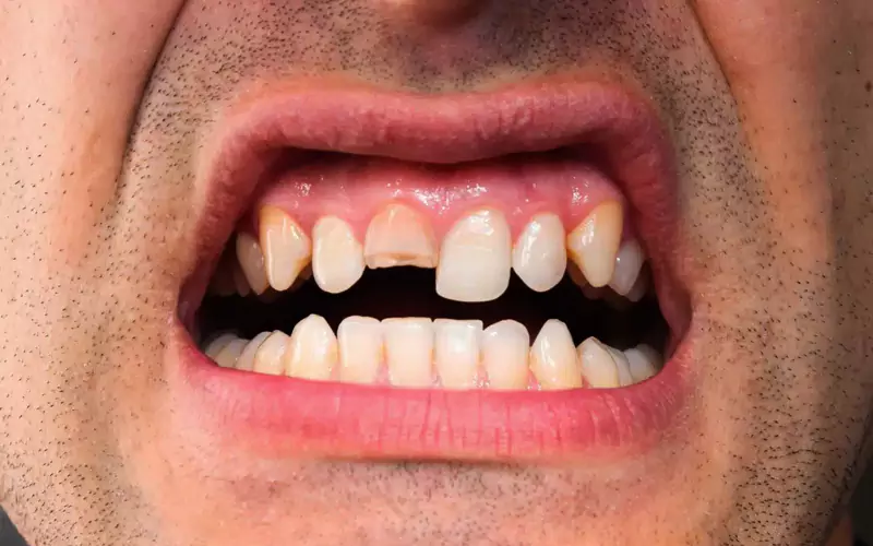 What Is a Tooth Extraction? Procedure, Risks, and Recovery