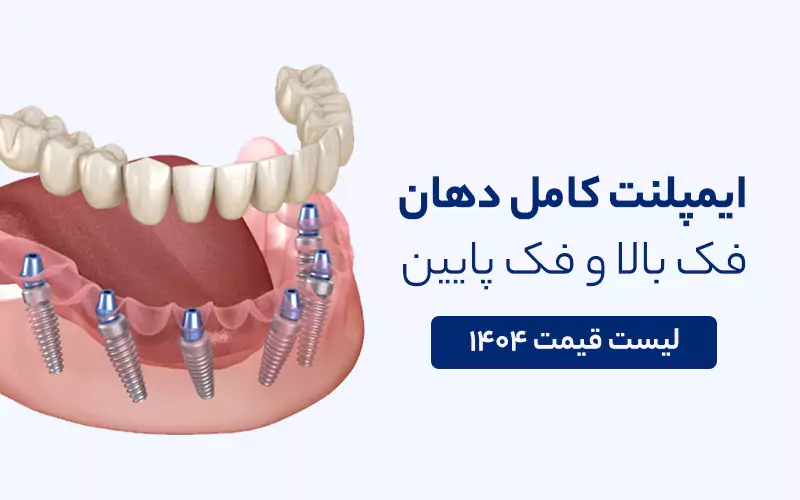 قیمت ایمپلنت کامل دهان و فک بالا و پایین 1405