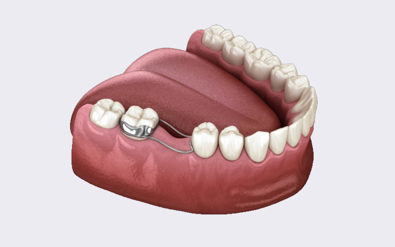 فضا نگهدارنده دندان کودک چیست؟