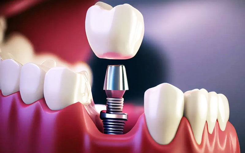Abutment for Dental Implant
